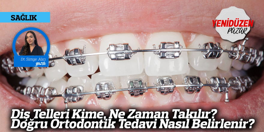 Diş Telleri Kime, Ne Zaman Takılır? Doğru Ortodontik Tedavi Nasıl Belirlenir?