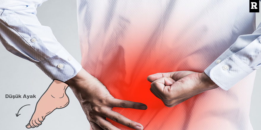 Bel Fıtığında Düşük Ayak Riski: Ameliyat Ne Zaman Gereklidir?