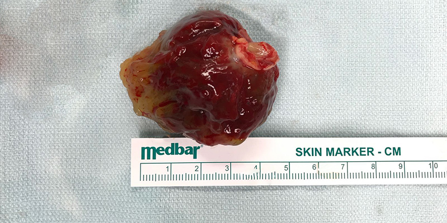 Kalbinden 5cm’lik tümör çıkarıldı