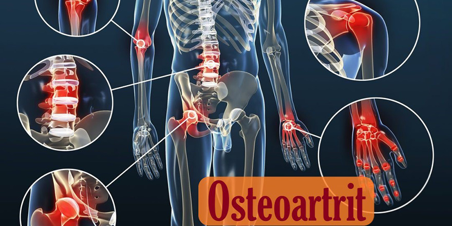 Osteoartrit nedir?
