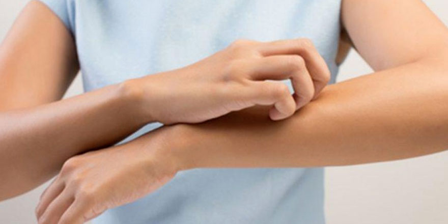 Egzama Hastalığı (Atopik Dermatit) Nedir? Belirtileri ve Nedenleri Nelerdir?