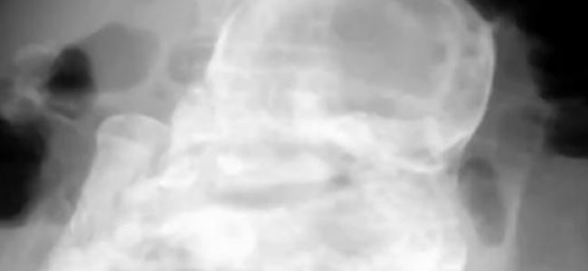 Karnından 40 yıllık fetüs çıktı