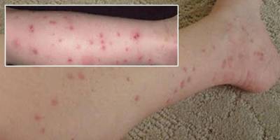 Mağusa’da ‘sivrisinek’ korkusu