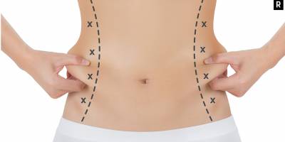 Liposuction ve Estetik Yöntemleri