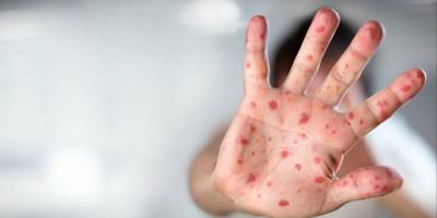 10 soruda "Maymun Çiçeği" hastalığı...