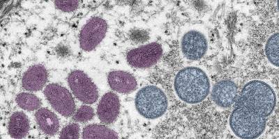 Maymun çiçeğinden Avrupa’daki ilk ölüm İspanya’da gerçekleşti