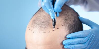 Saç ekimi için mevsim fark etmiyor