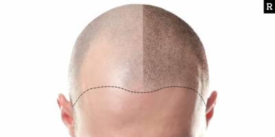 Kaliteli Saç Ekimi Merkezleri