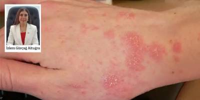 Gürçağ: Uyuz salgını yok