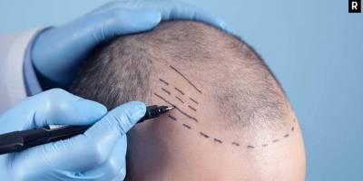 İstanbul’da En İyi Sac Ekimi Merkezi Hangisi? Saç Ekim Fiyatları Ne Kadar?
