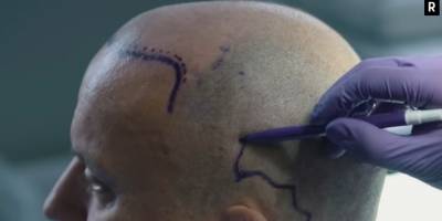 2024 Saç Ekim Fiyatları ve İstanbul’da En İyi Saç Ekim Merkezleri