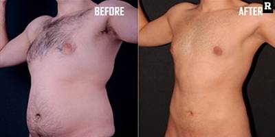 Vaser Liposuction ve J Plasma ile Vücut Şekillendirmede Yeni Dönem