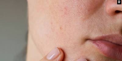 Yaz yaklaşırken cilt tipine uygun güneş kremi seçiminin önemi