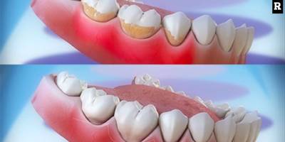 Diş Taşı Temizliği Neden Önemlidir?