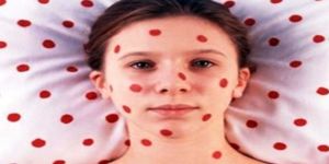 Dünyada kızamıktan ölenlerin sayısı arttı