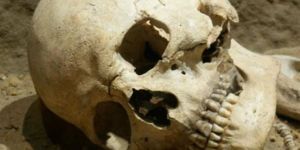Bin yıllık ameliyat kafatasının izinden belli oldu