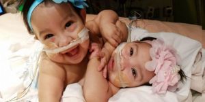 Siyam ikizler için yeni başlangıç