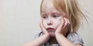 Kızamık vakalarında artış görüldü