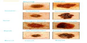 YAZ GELDİ ‘CİLT KANSERİ’NE DİKKAT