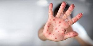 3 öğrencide ‘el ayak ağız hastalığı’!