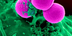 Sjögren hastalığı nedir?