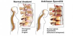 Ankilozan Spondilit