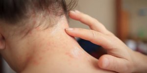 Sedef Romatizması  (Psöriatik Artrit )