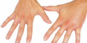 Skleroderma (Sistemik skleroz )