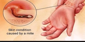 Uyuz hastalığında artış