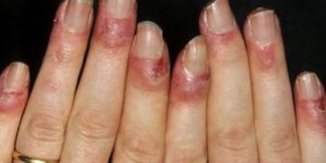 Bağ Dokusu Hastalığı nedir?