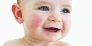 Çocukluk Çağı Ekzeması (Atopik Dermatit)