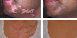 Derideki Renk Değişikliklerinde Kozmetik Kamuflaj