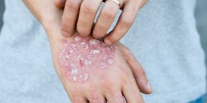 Sedef Hastalığı Nedir? Sedef Hastalığı Belirtileri, Nedenleri ve Tedavileri