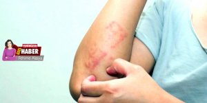 Askeri birliklerde uyuz sorunu