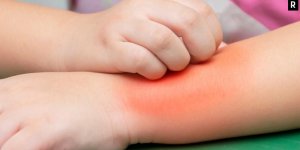 Ürtiker (Kurdeşen) Nedir?