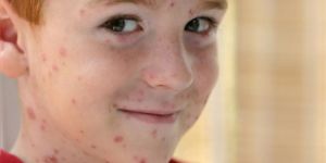 İskelede su çiçeği salgını