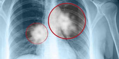 Pasif içicilik de kansere neden olabiliyor